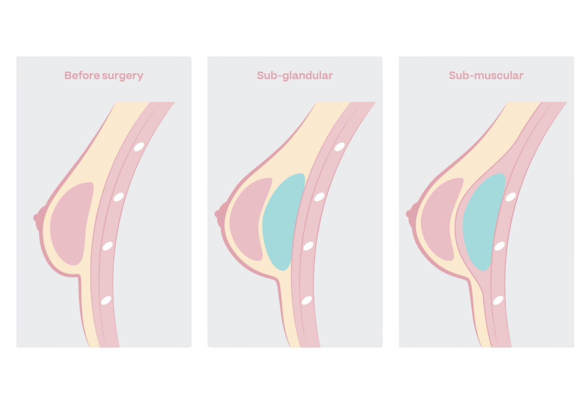 Diagram on implant placement for breast enlargement. before the muscle or behind the muscle, between the breast tissue and chest muscle (sub-glandular) or behind the chest muscle (sub-muscular) Diagram on implant placement for breast enlargement. before the muscle or behind the muscle, between the breast tissue and chest muscle (sub-glandular) or behind the chest muscle (sub-muscular)